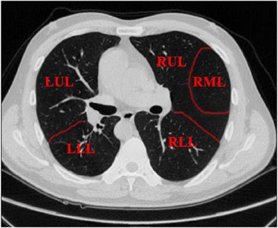 Edge-enhancement cascaded network for lung lobe segmentation based on CT images
